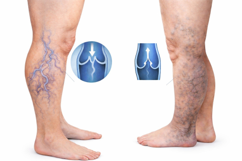 Варикоз или хроническая венозная недостаточность: в чем разница и почему это важно
