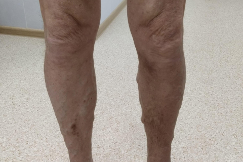 Лечение варикозной болезни с изменениями кожи - результат комплексной терапии